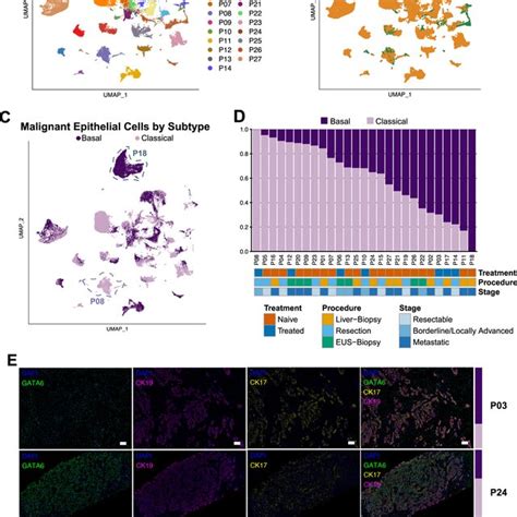 Single Cell Analysis Reveals The Transcriptomic Landscape In Pdac A Download Scientific Diagram