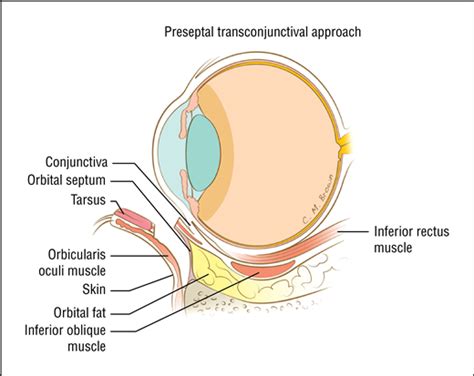 Dry Eye Symptoms And Chemosis Following Blepharoplasty A 10 Year