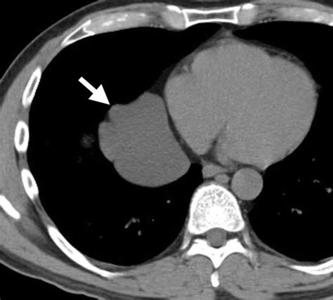 Airp Best Cases In Radiologic Pathologic Correlation Migrating Pericardial Cyst Radiographics