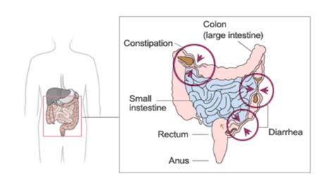 Irritable Bowel Syndrome (IBS) - Gastroenterologist