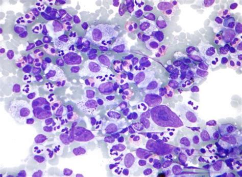 Hematology Lymphomas Hodgkins Non Hodgkins Simplenursing