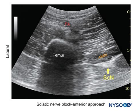 regional-anesthesia-sciatic-nerve-block-anterior-approach - NYSORA | NYSORA