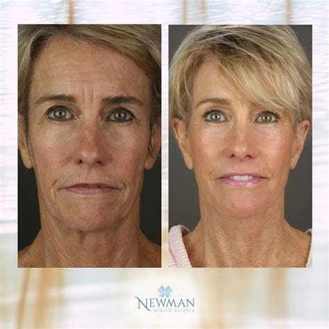 Deep Plane Facelift Temecula Plastic Surgery