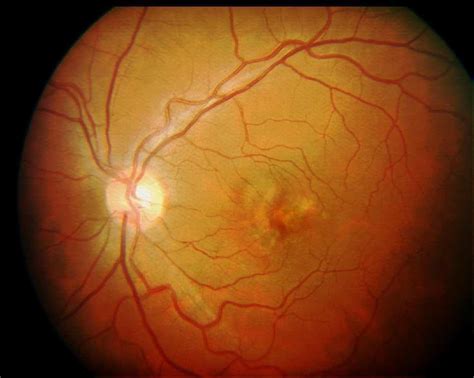 Degeneraci N Macular Relacionada Con La Edad Dmre Centro Nacional