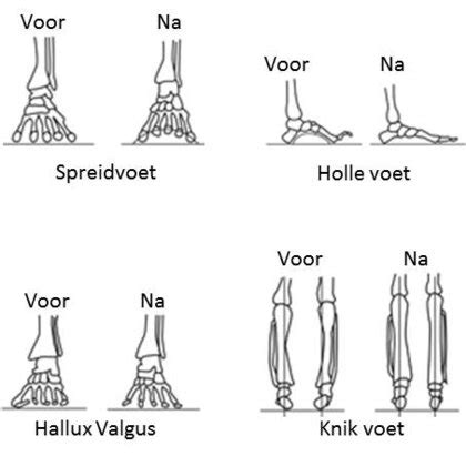 Holvoet Fusselastic Steunzolen