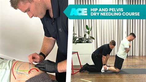 Hip And Pelvis Dry Needling Course YouTube