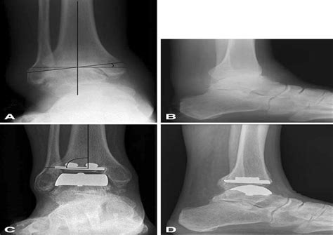 The Scandinavian Total Ankle Replacement Survivorship At 5