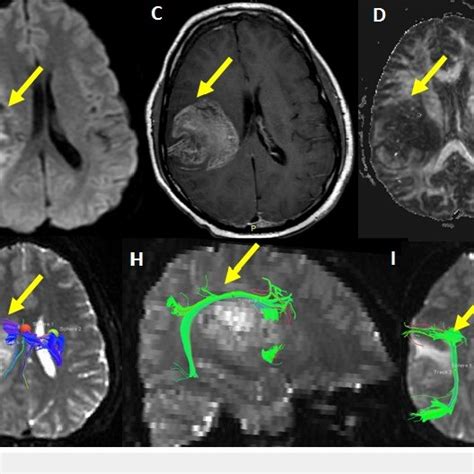 Whole-brain tractography Whole-brain tractography shows coronal (A ...