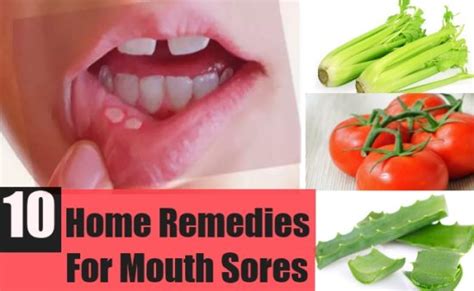 Home Remedies for Mouth Sores, Causes, How to Cure Mouth Sores