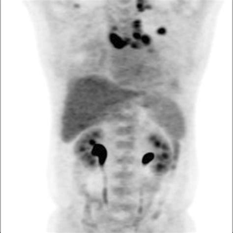 (A) Biopsy specimen from the right lower paratracheal lymph node ...