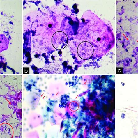 The Cytopathological Features Of Bacterial Vaginosis A Sparse Download Scientific Diagram