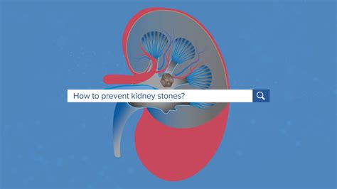 What Causes Kidney Stones? > News > Yale Medicine