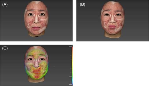 Nose. The wrinkles of the nasal dorsum are mainly caused by the nasalis ...