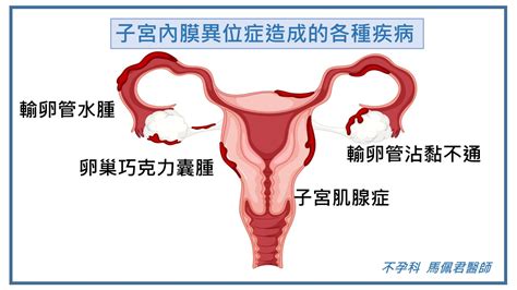 馬佩君醫師助孕醫學講座 『從經痛到不孕』系列講座之一 了解「子宮內膜異位症」為何影響懷孕