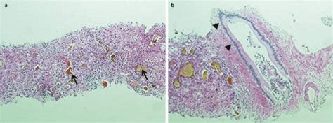 Liver Biopsy Showed Submassive Hepatic Necrosis And Cholestasis Download Scientific Diagram