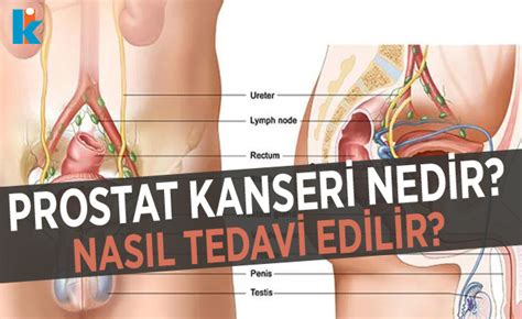 Prostat Kanseri Nedir Belirtileri Ve Tedavi Y Ntemleri Nelerdir