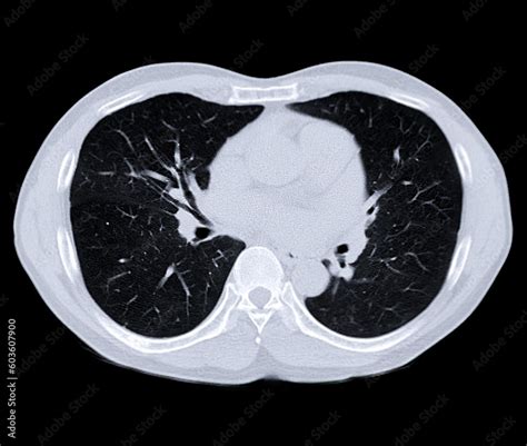 CT scan of Chest or lung for screening lung nodules and lung cancer . Stock Illustration | Adobe ...