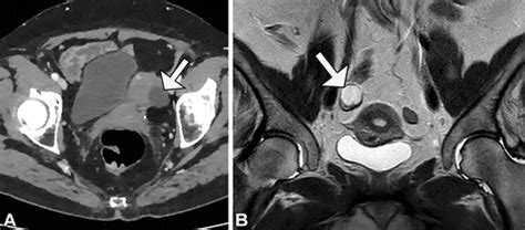 Benign Appearing Incidental Adnexal Cysts At US CT And MRI Putting