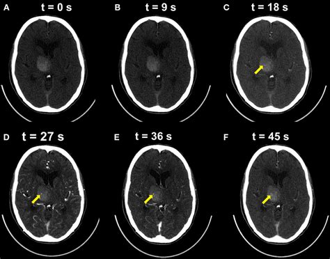 Frontiers Intracerebral Hemorrhage Towards Physiological Imaging Of Hemorrhage Risk In Acute