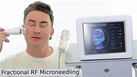 Fractional Radiofrequency Microneedling Skin Tightening Before