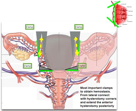 Emergency Peripartum Hysterectomy Rural Surgery And Obstetrics