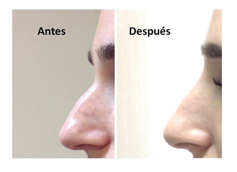 Rinoplastia Sin Cirugia Clinica Bayton Madrid Clinica Bayton