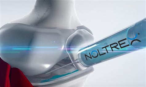 NOLTREX™ – płynna endoproteza | Przychodnie i Szpital Grupa Avimed