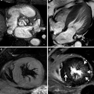 Asymmetric Hypertrophic Cardiomyopathy In A Years Old Man Showed