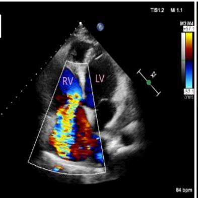 A Apical 4 Chambers View LV Sub Pulmonary LV RA Right Atrium RV