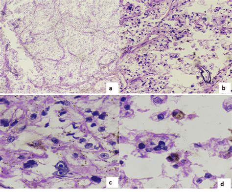 Microphotograph Showing A Tumor Cells Arranged In Nested To