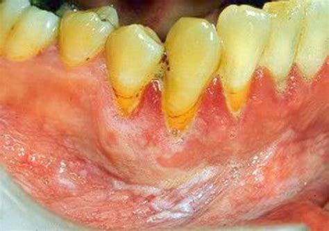 Frictional Keratosis