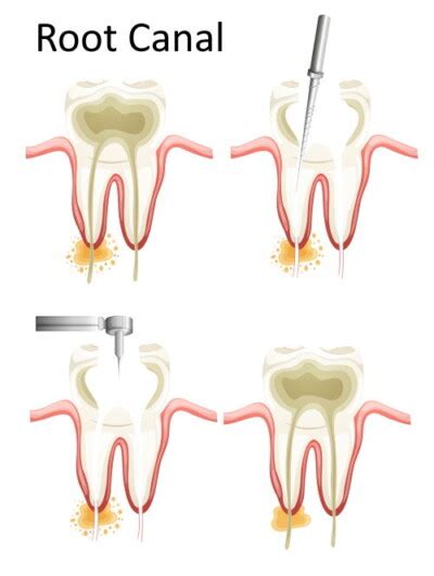 baby root canal recovery - Jenell Chase