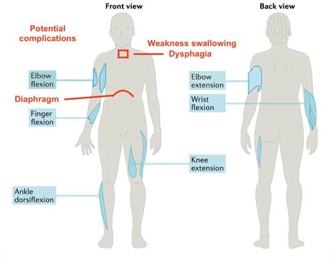 Inclusion Body Myositis Muscle Disease Hot Sex Picture