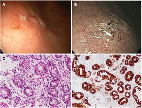 Adenocarcinoma Stomach Cancer | Stomach Cancer Treatment – TERSIR