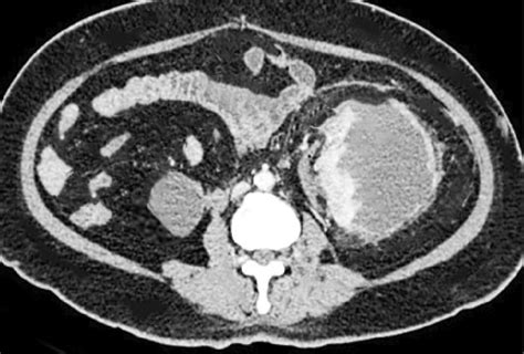 Figure CT Scan Showing Page Kidney Contributed By Rian Kabir MD