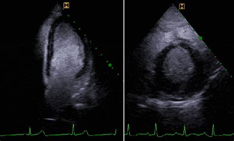 Ecocardiografia De Estresse Parte 8 Blog Ecope