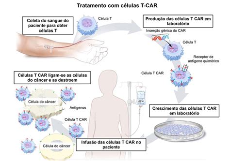 Células de paciente são usadas em tratamento contra câncer Sociedade