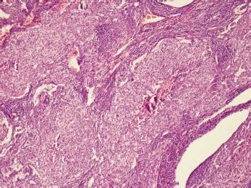 Biphasic Synovial Sarcoma H E X100 Figure 4 Epithelioid And Spindle