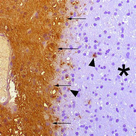 The Luxol Fast Blue Combined With Periodic Acid Schiff Lfb Pas