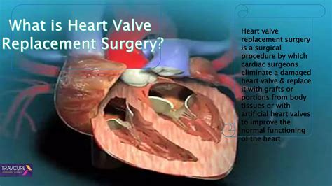 Heart valve replacement surgery procedure | PPT