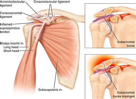 Injection Technique For Subacromial Impingement Syndrome Clinical Tree