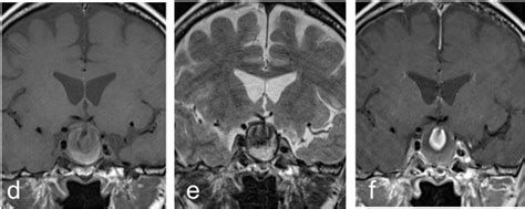 Intrasellar Aneurysm Radiology Cases