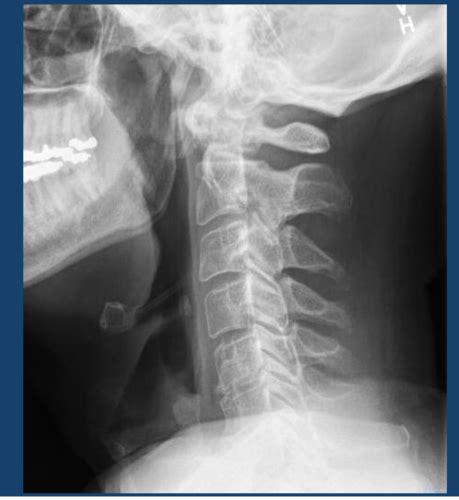 Radiographic Evaluation Flashcards Quizlet