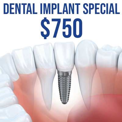 $750 for Affordable Dental Implants in El Paso, TX!