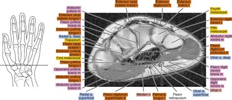 MRI Of The Wrist Radiology Key