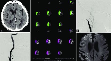 A Noncontrast Computed Tomography Head Axial Image No Evidence Of