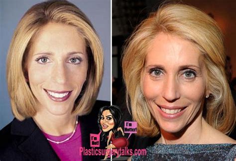 Dana Bash Plastic Surgery Before & After - Plastic Surgery Talks