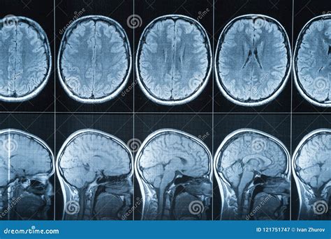 Magnetic Resonance Imaging Of The Head Mri Stock Image Image Of Coil