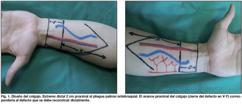 Cierre De Zona Donante De Colgajo Libre Radial De Antebrazo Con Colgajo