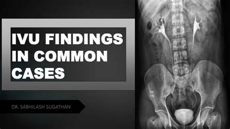 IVU FINDINGS.pptx